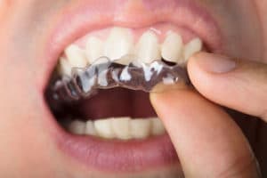 Braces-Frequently-Asked-Questions