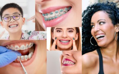 The Ultimate Guide to Getting Braces in Chicago: What You Need to Know