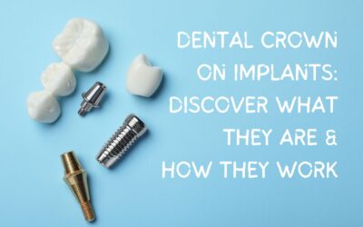 Dental Crowns on Implants: The Key To Your New Smile