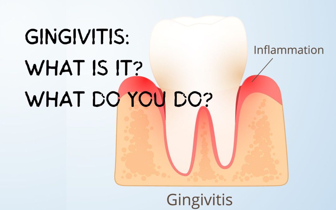 Gingivitis:  What Is It? What Do You Do About It?