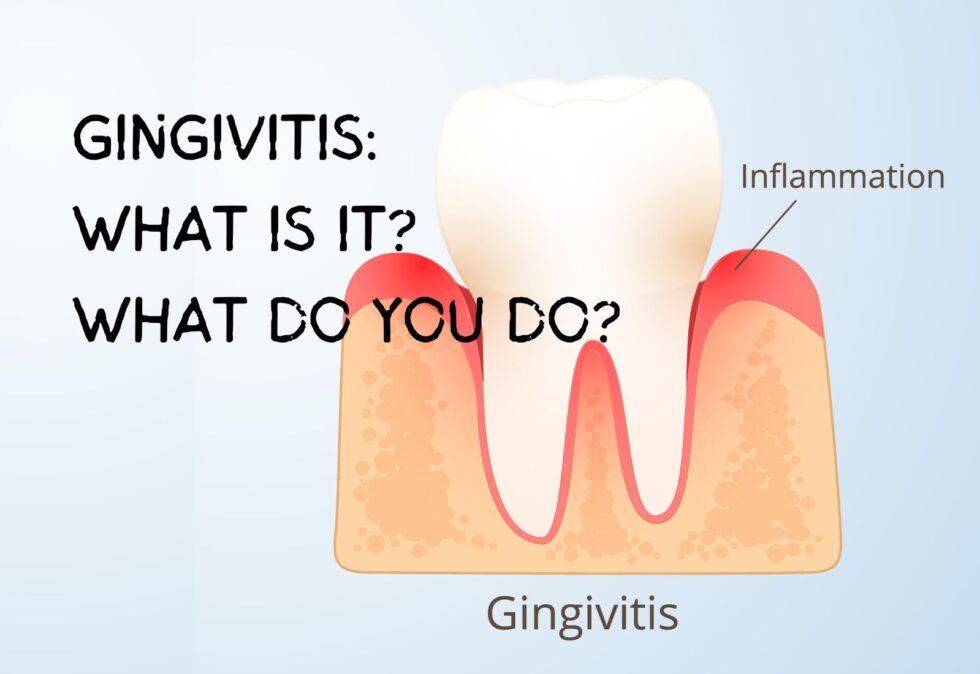 Gingivitis What Is It? What Do You Do About It? ABC Dental l Rated