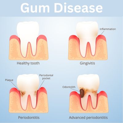 Deep Cleaning - Gum Disease and the Heart
