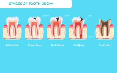 What are the stages of tooth decay?