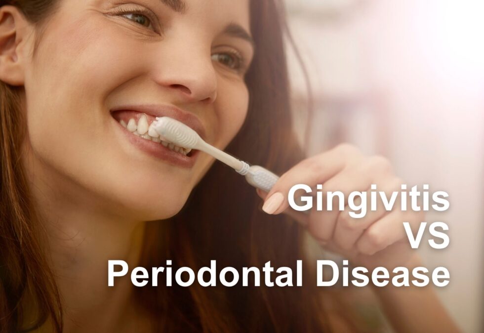 Gingivitis VS. Periodontal Disease ABC Dental l Rated Best Chicago