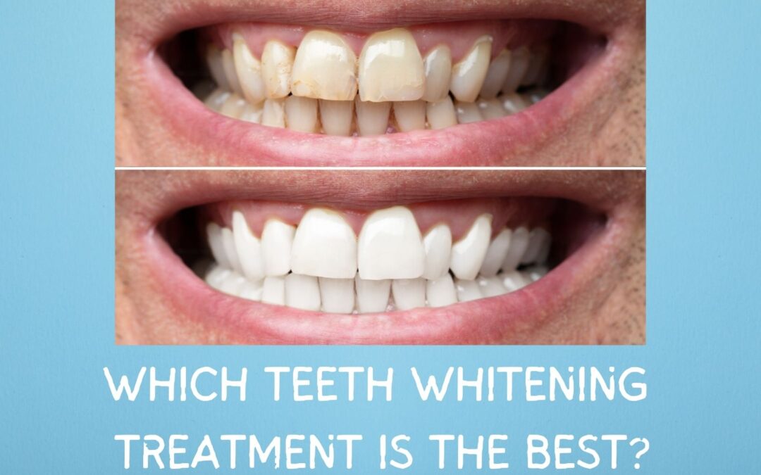 Best Teeth Whitening Chicago