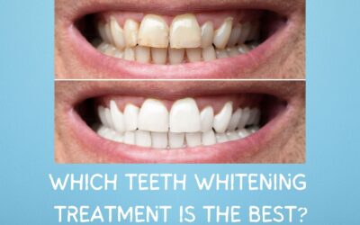 Which Teeth Whitening Treatment is the Best?