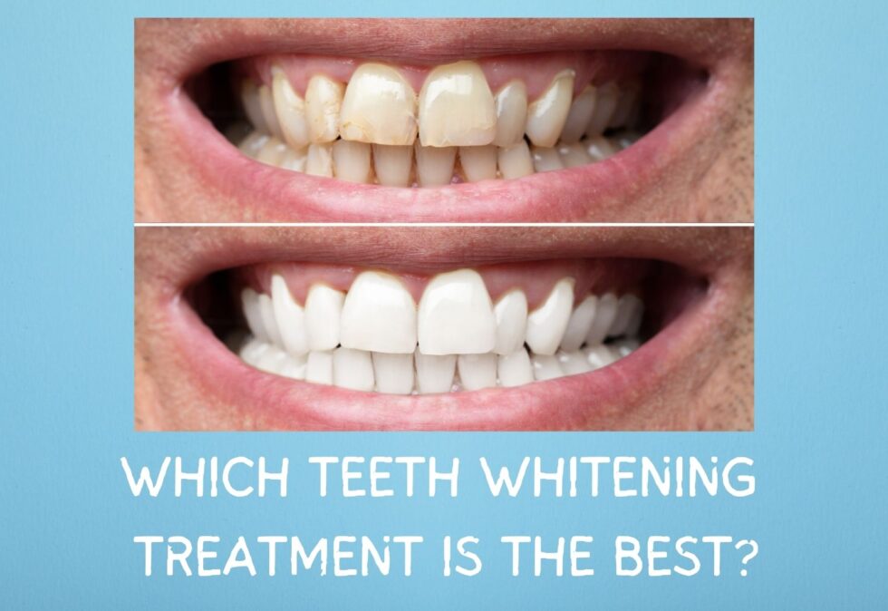 Which Teeth Whitening Treatment is the Best? ABC Dental l Rated Best Chicago Dentist and